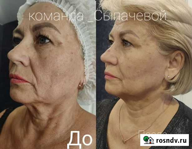 Холодная плазма Астрахань - изображение 1