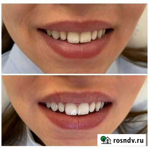 LED лампа отбеливание зубов Челябинск - изображение 1