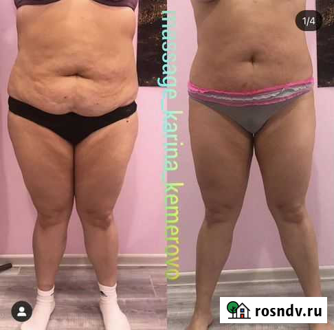 Вакуумный массаж/Кавитация/РФ лифтинг Кемерово - изображение 1