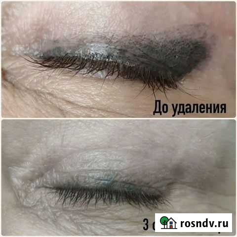 Удаление татуажа Ханты-Мансийск - изображение 1