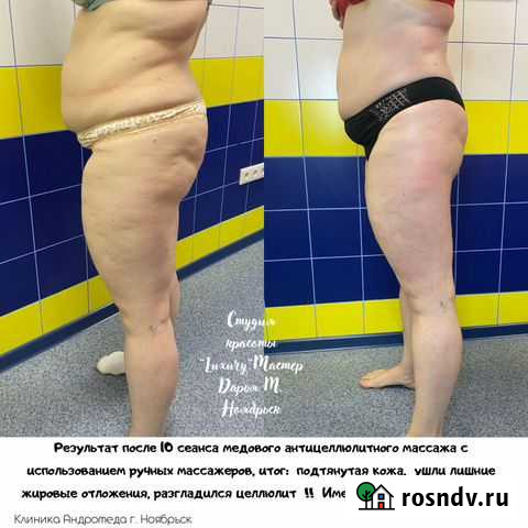 Массаж медовый, аппаратный, криолиполиз Ноябрьск - изображение 1