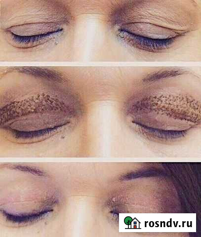 Лазерный аппаратный плазмолифтинг Сочи - изображение 1