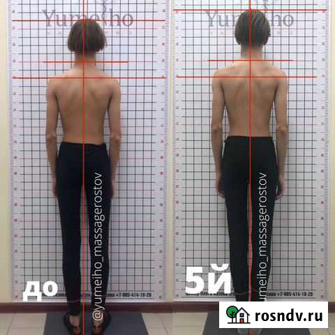 Исправление сколиоза у детей и взрослых Ростов-на-Дону - изображение 1