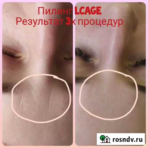 Чистка лица,пилинги.Массаж лица Ростов-на-Дону - изображение 1