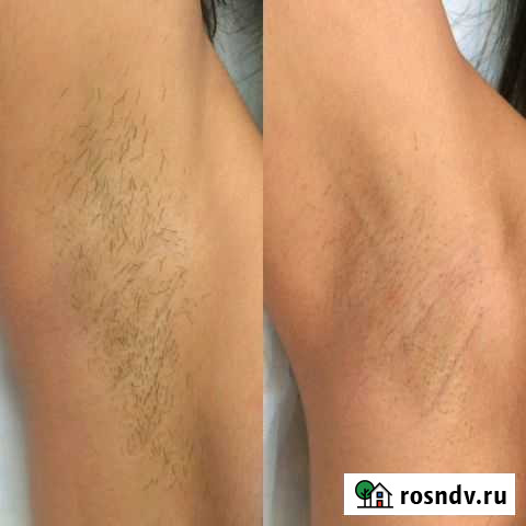 Шугаринг муж.и жен.Сахар,воск,пленочный воск Пенза - изображение 1