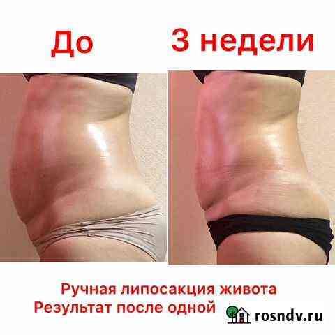 Ручная липосакция Самара