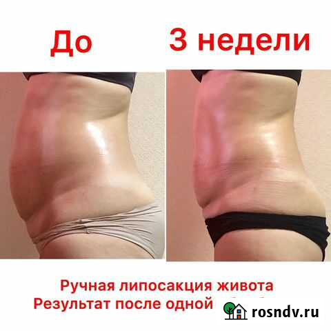 Ручная липосакция Самара - изображение 1