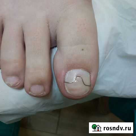 Медицинский педикюр Тосно - изображение 1