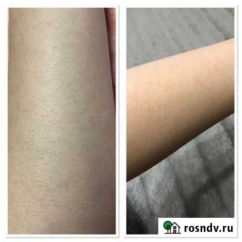 Шугаринг, воск,Депиляция Каспийск - изображение 1