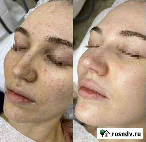 Итальянский пилинг, пигментации, очищение, сияние Махачкала