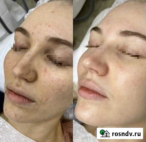 Итальянский пилинг, пигментации, очищение, сияние Махачкала - изображение 1