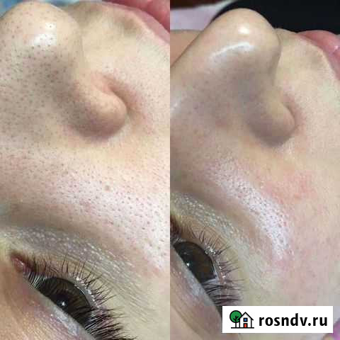 Косметолог чистка лица Махачкала - изображение 1