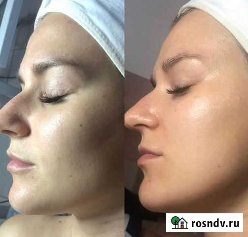 Пилинг для лица,шеи и декольте,чистка Севастополь - изображение 1