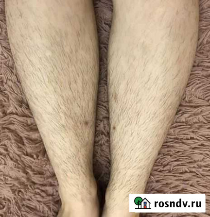 Электроэпиляция Махачкала - изображение 1