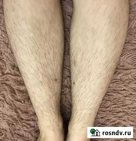 Электроэпиляция Махачкала - изображение 1