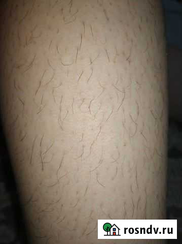 Электроэпиляция Махачкала - изображение 1