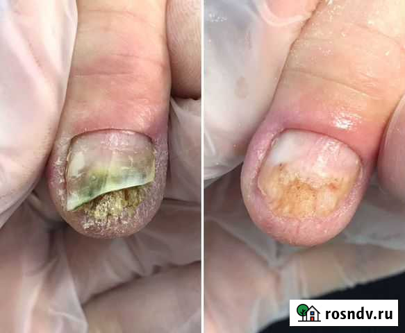 Медицинский педикюр. Вросший ноготь Череповец - изображение 1