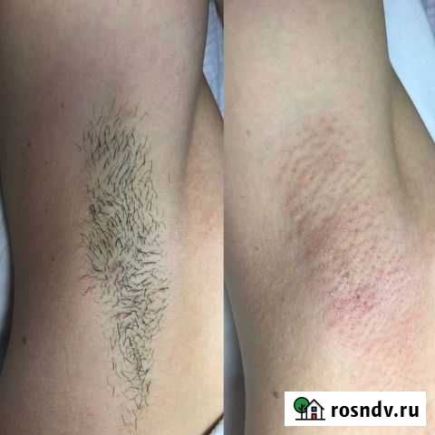 Электроэпиляция Щёлково - изображение 1