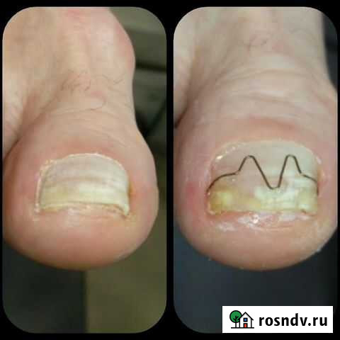 Подолог. медицинский педикюр. Г. Королёв Королев - изображение 1