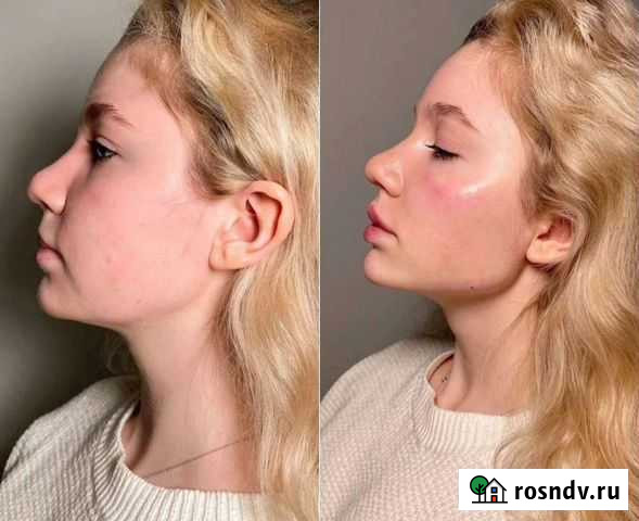 Smas лифтинг лица и тела Городище - изображение 1