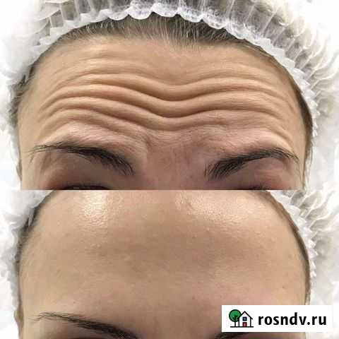 Ботокс для лица Ростов-на-Дону - изображение 1