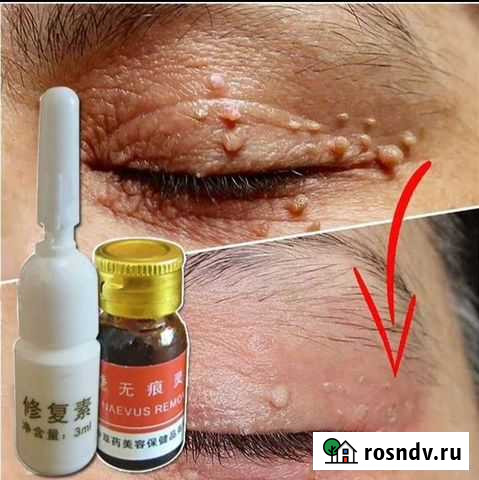 Средство для удаления бородавок Абакан - изображение 1