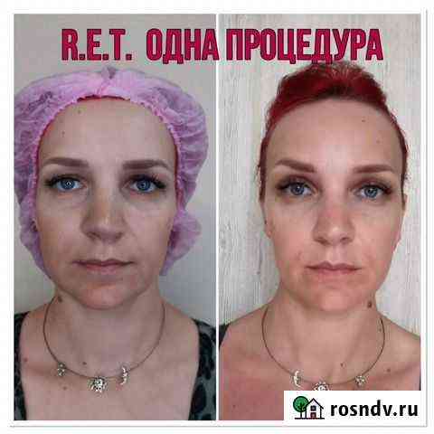 Аппаратная косм-гия (лицо).Естественное омоложение Калининград