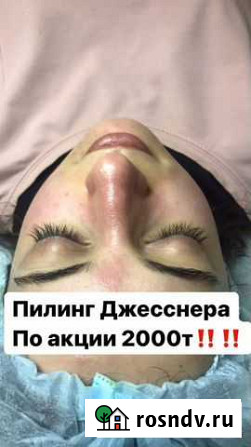 Пилинг джесснера Махачкала - изображение 1