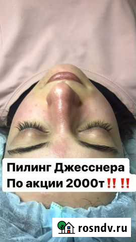 Пилинг джесснера Махачкала - изображение 1