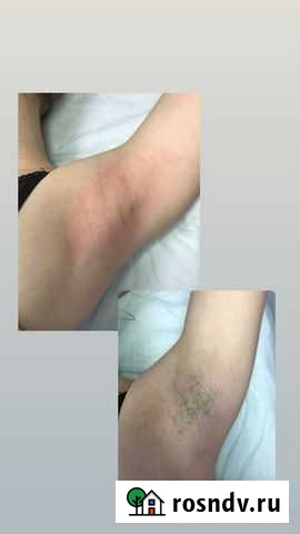 Эпиляция на дому Москва - изображение 1