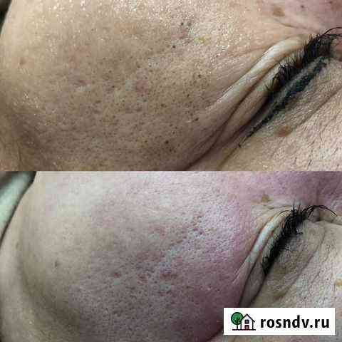 Чистка лица Сургут
