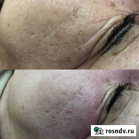 Чистка лица Сургут - изображение 1