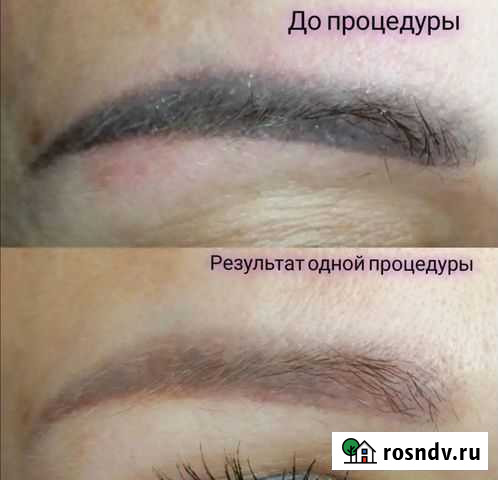 ScinOne X - бережное удаление тату лазером Москва - изображение 1