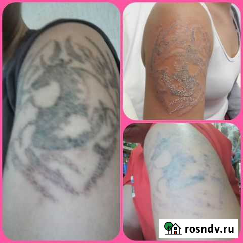 Лазерное удаление татуировок Воронеж - изображение 1