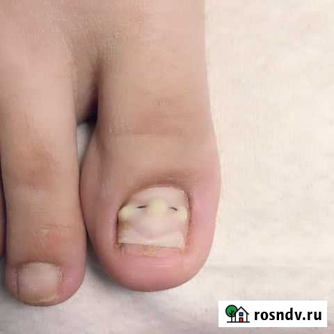 Лечение вросших ногтей Саратов - изображение 1