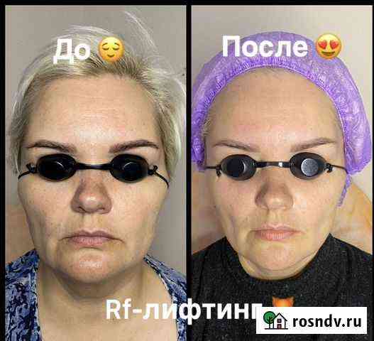 Rf лифтинг Железногорск