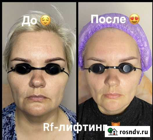 Rf лифтинг Железногорск - изображение 1
