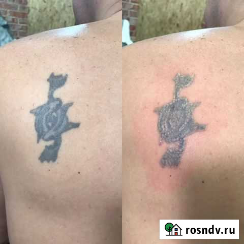 Лазерное удаление Энгельс - изображение 1