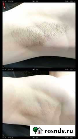 Шугаринг Йошкар-Ола - изображение 1