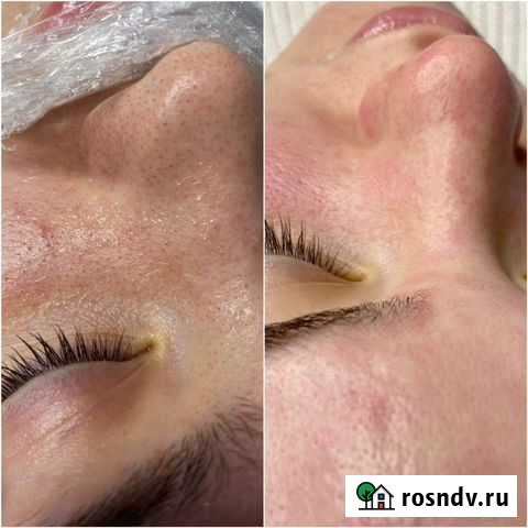 Чистка лица / косметолог Чебоксары - изображение 1