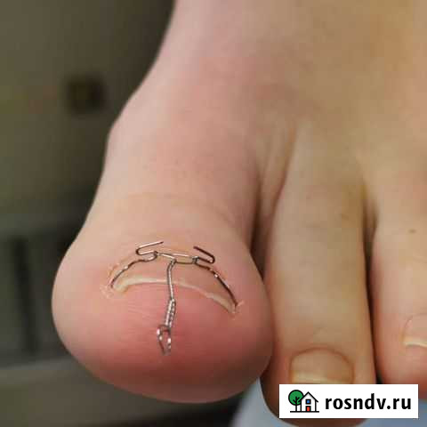 Медицинский педикюр, скобы 3то, фрезера, наспан Санкт-Петербург - изображение 1