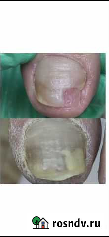 Медицинский педикюр, маникюр Ульяновск - изображение 1