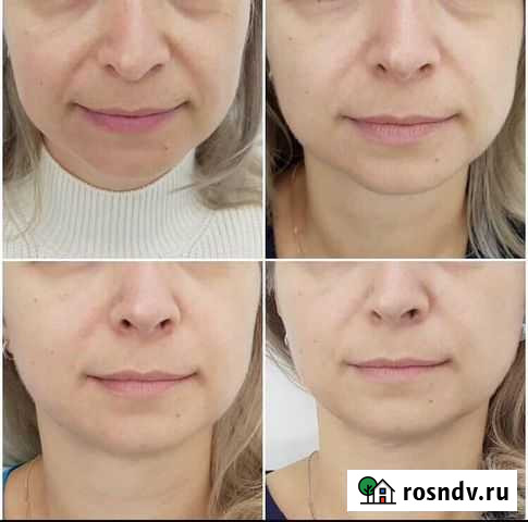 Скульптурно-буккальный массаж лица Ульяновск - изображение 1