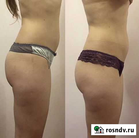 Lpg массаж Сочи - изображение 1