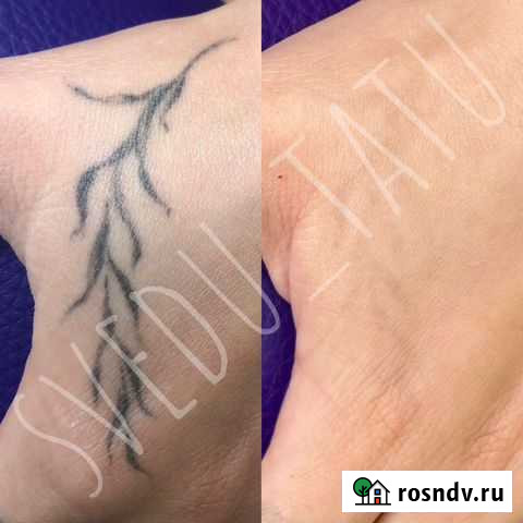 Лазерное удаление татуировок и татуажа Пирсинг Москва - изображение 1