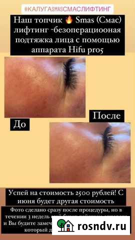 Смас лифтинг процедура Калуга - изображение 1
