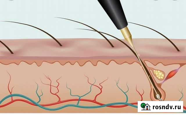 Электроэпиляция Махачкала - изображение 1