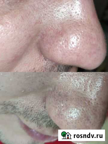 Косметолог (Комплекс Чистка+ пилинг+маска) Краснодар - изображение 1