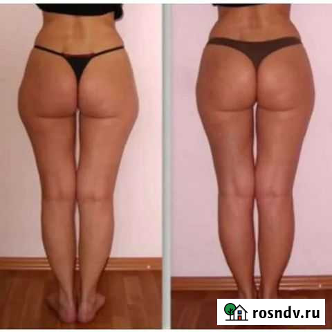 Массаж - Ручная липосакция Новомосковск - изображение 1