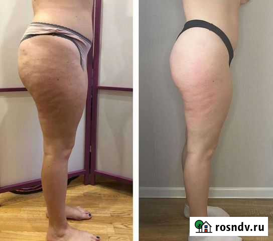 Массаж Липопластика скульптор тела Саратов - изображение 1